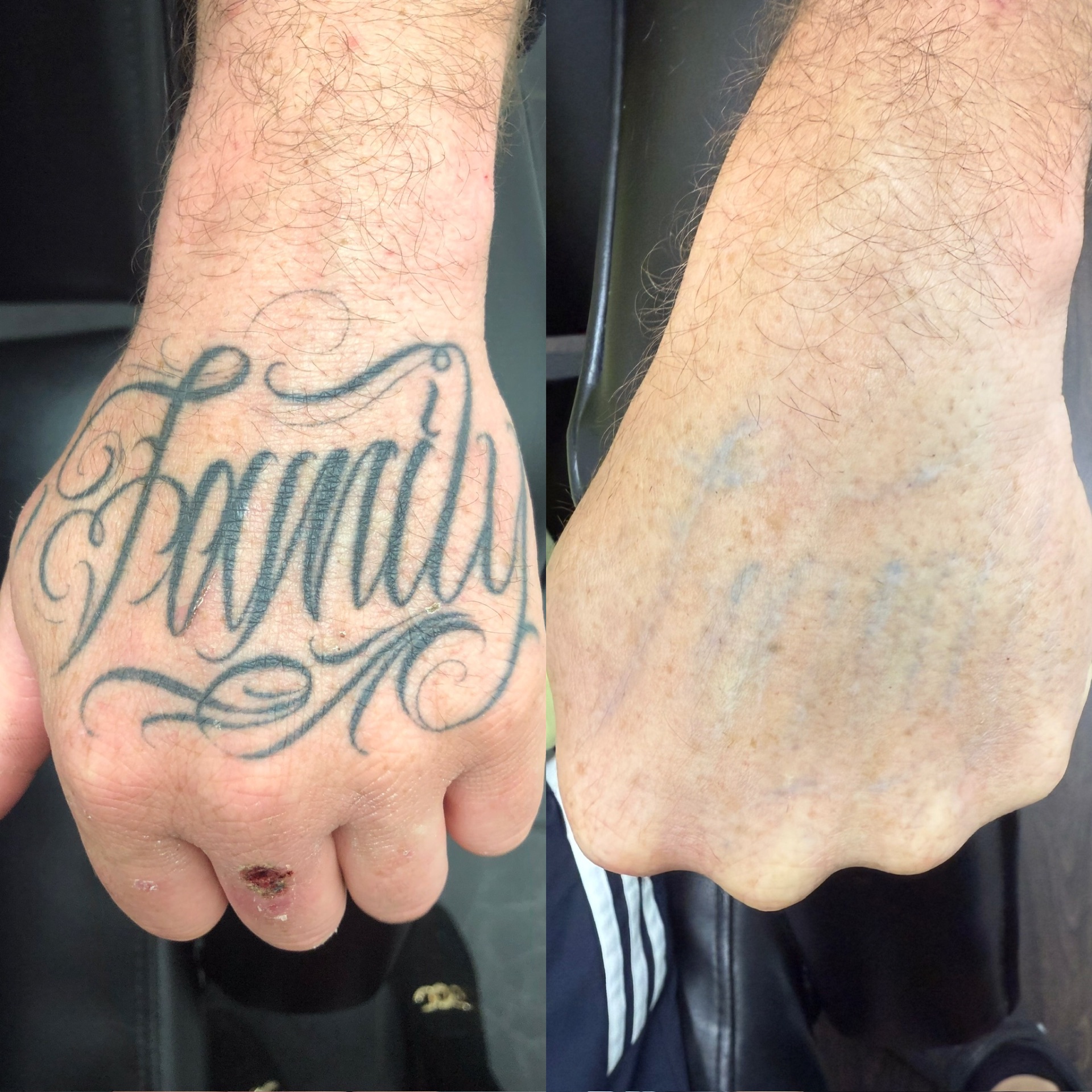 Before and after of a 'Family' script hand tattoo nearly fully removed by laser.