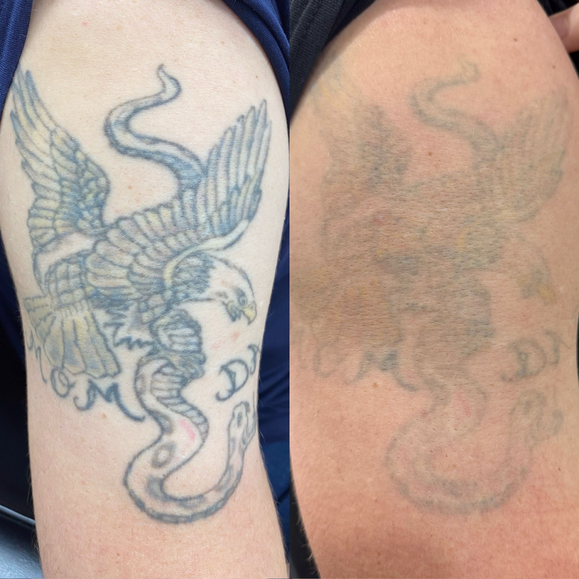 Before and after of a colour eagle arm tattoo faded by laser removal.