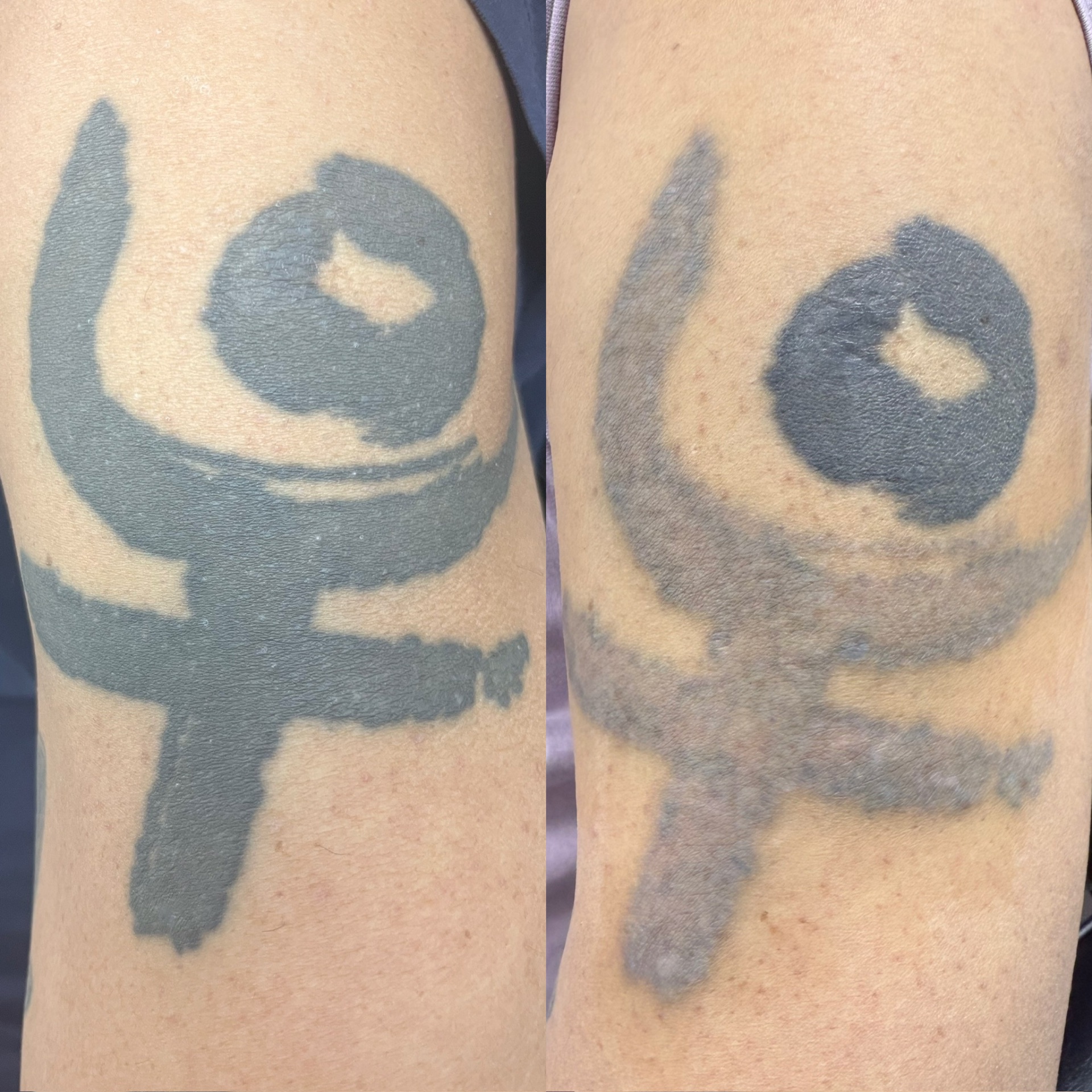 Before and after of a bold arm symbol tattoo faded by laser.