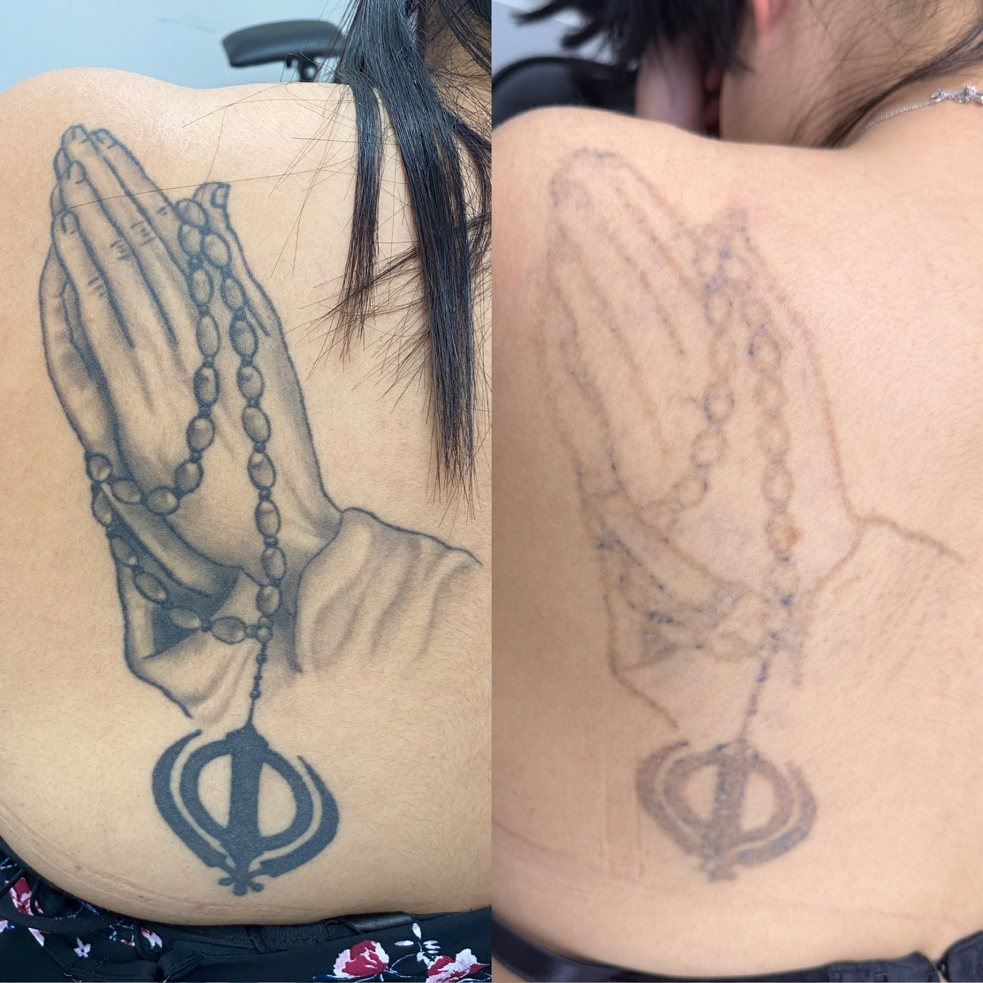 Before and after of a praying hands and Khanda back tattoo faded by laser.
