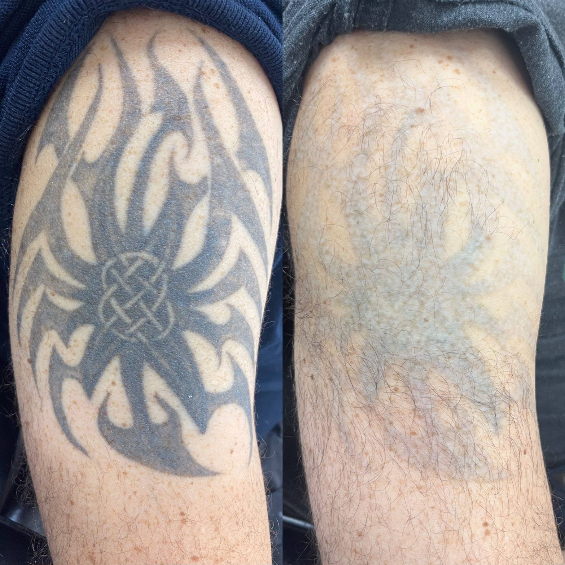 Before and after of a large tribal arm tattoo significantly faded by laser removal.