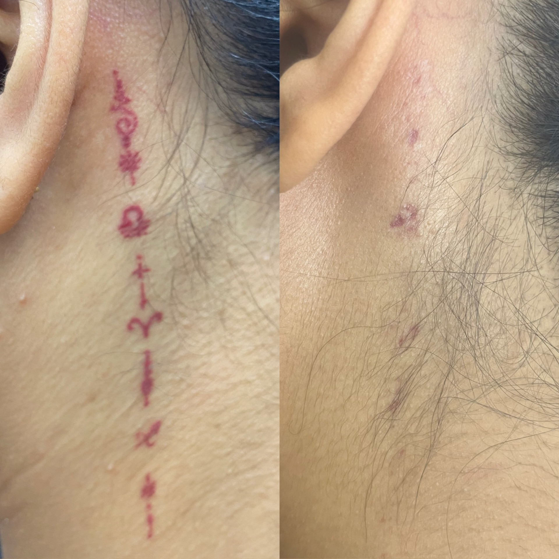 Before and after of a red script neck tattoo almost fully removed by laser.