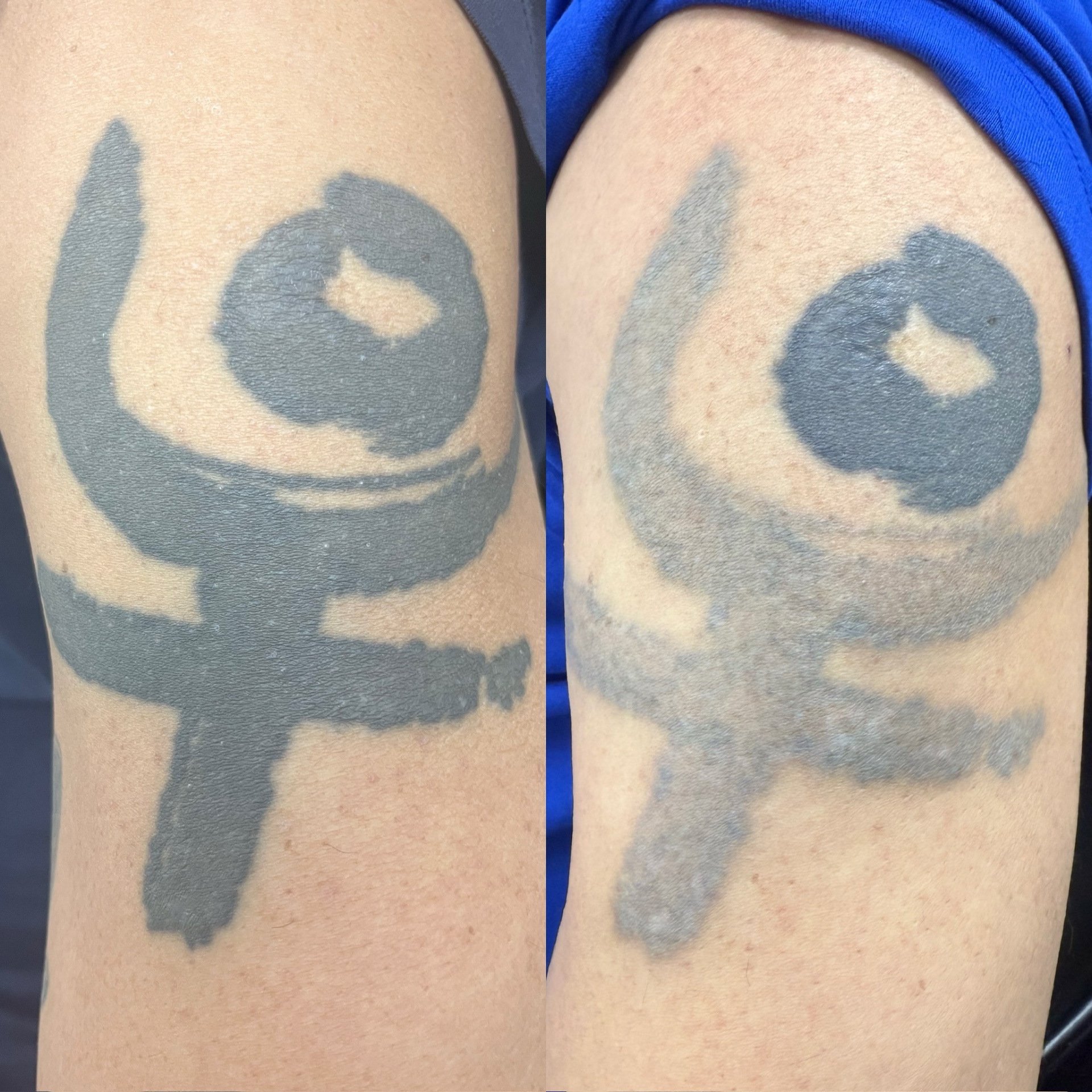 Before and after of a solid black arm symbol tattoo lightened by laser.