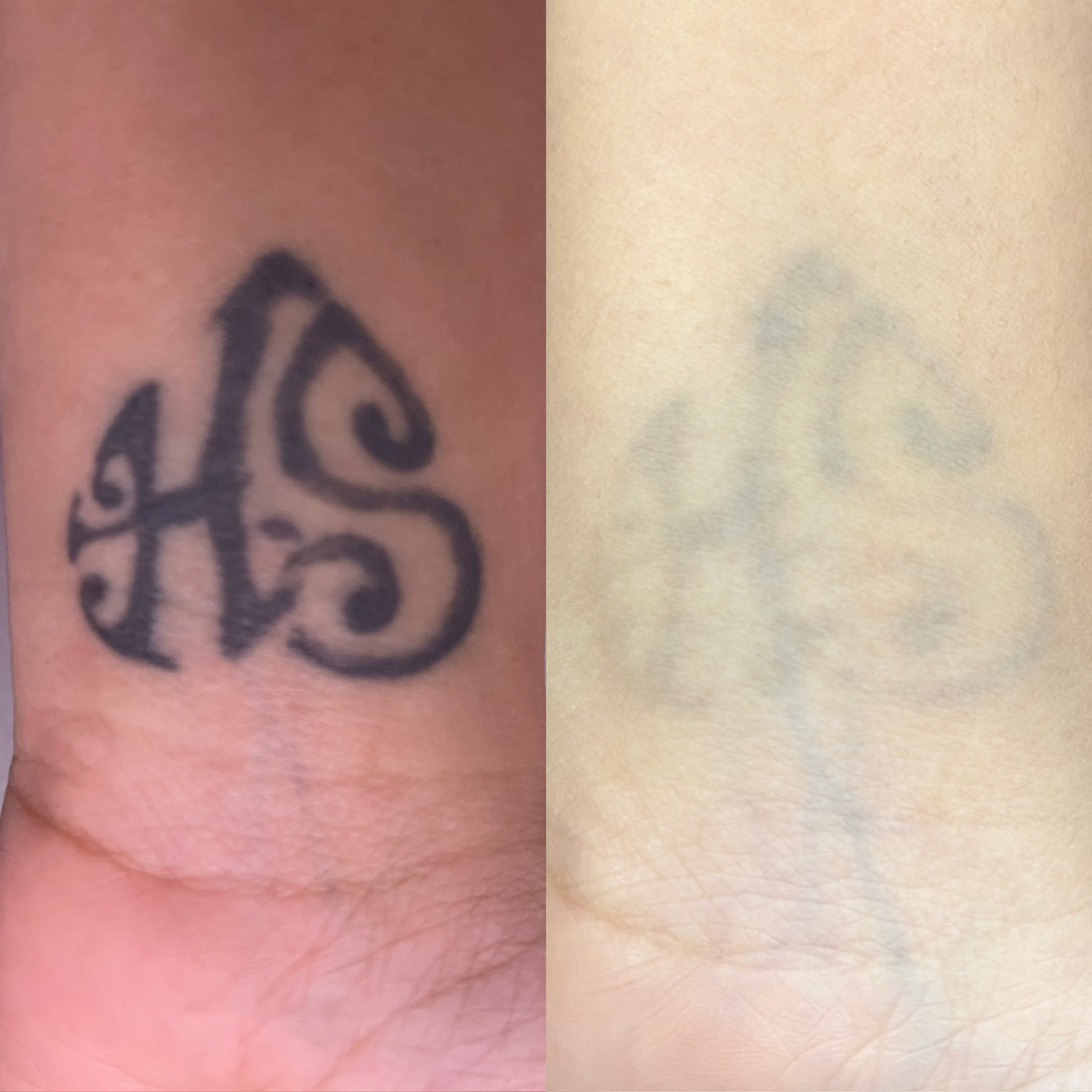Before and after of an 'HS' monogram wrist tattoo lightened by laser.