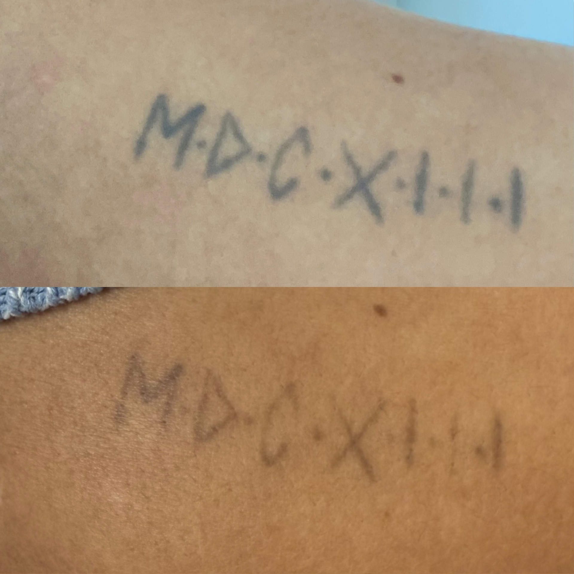 Before and after of an 'MDCXIII' lettering tattoo faded by laser.
